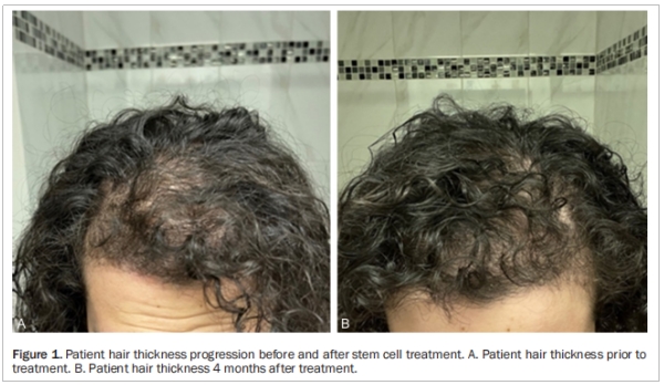 多囊卵巢綜合征臨床試驗