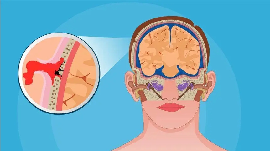 創(chuàng )傷性腦損傷 創(chuàng )傷性腦損傷