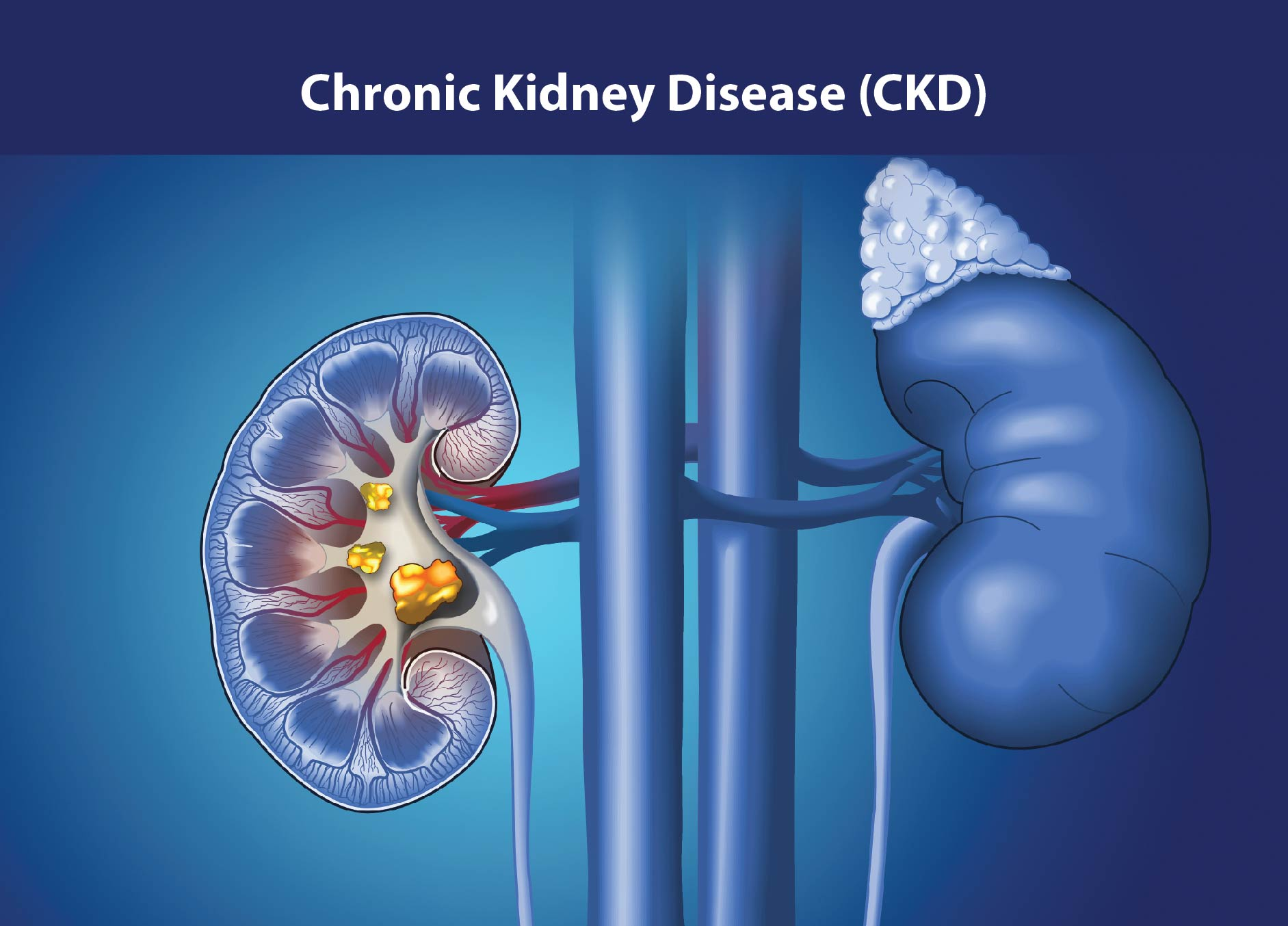 慢性腎病治療新策略：間充質(zhì)干細胞如何修復腎功能、延緩疾病進(jìn)展？