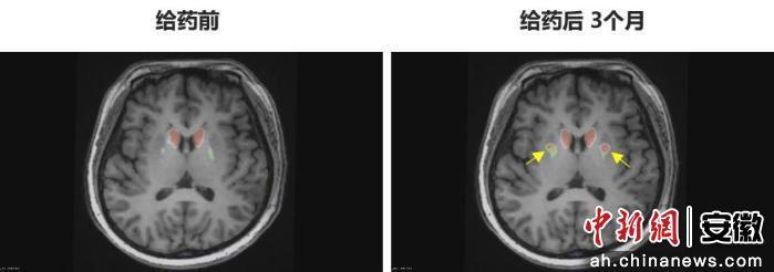 圖為李女士 PET-DAT/MRI融合圖像術(shù)前與術(shù)后三個(gè)月對比。