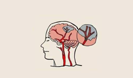 中風(fēng)后的腦損傷，真的能被干細胞療法逆轉嗎？