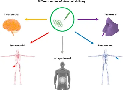 干細胞移植途徑：該圖展示了用于中風(fēng)治療的干細胞輸送途徑，包括腦內（立體定向注射）、血管內（靜脈/動(dòng)脈）、腹腔內、腦室內、靜脈內、鼻內和鞘內注射方法。