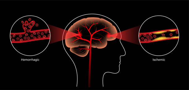 臍帶干細胞靜脈注射治療腦卒中？Ⅰ期人體研究結果公布：臨床顯示安全有效