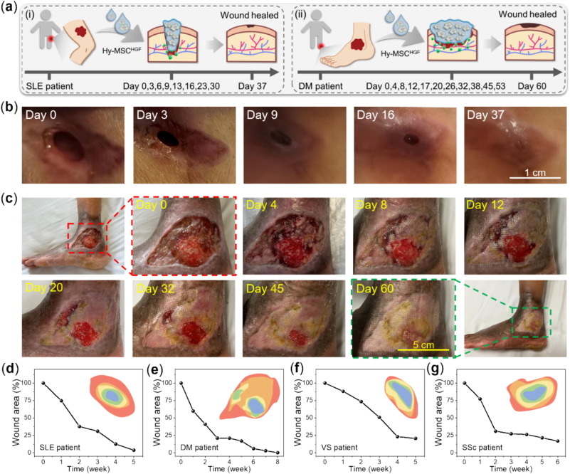 圖：MSC-HGF負載水凝膠在臨床上治愈人類(lèi)RW傷口。